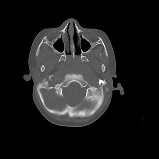 File:Bony atresia of the right external auditory canal (Radiopaedia 27916-28156 Axial bone window 1).jpg