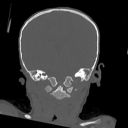File:Bony atresia of the right external auditory canal (Radiopaedia 27916-28156 Coronal bone window 8).jpg