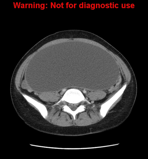 Borderline mucinous cystadenoma of ovary (Radiopaedia 25586-25767 A 61).jpg