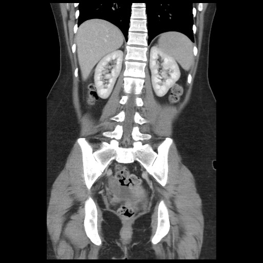 Borderline mucinous tumor (ovary) (Radiopaedia 78228-90808 C 36).jpg