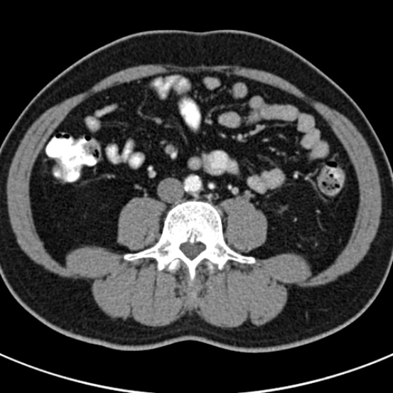 File:Bosniak cyst - type IV (Radiopaedia 23525-23627 renal cortical phase 48).jpg