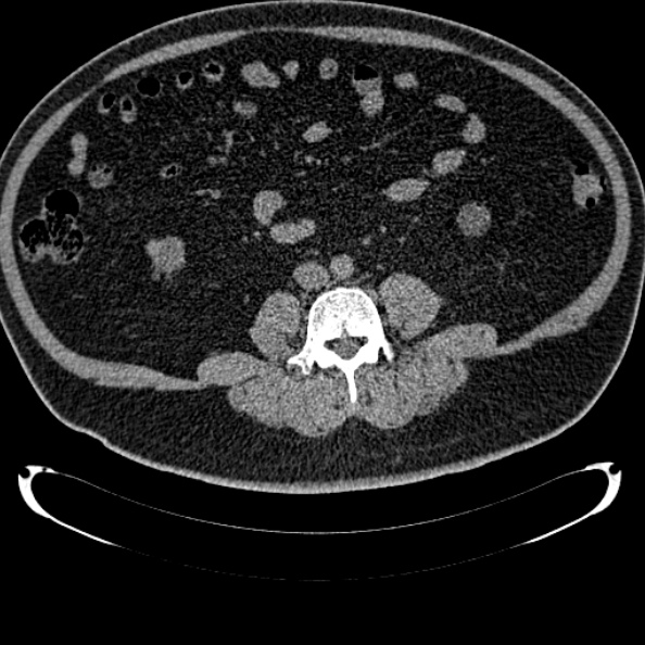 Bosniak renal cyst - type IV (Radiopaedia 24244-24518 Axial non-contrast 203).jpg
