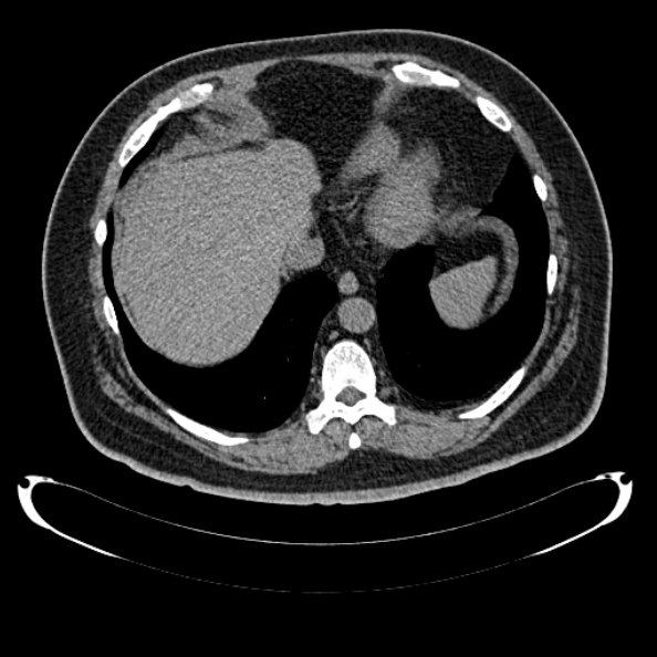 Bosniak renal cyst - type IV (Radiopaedia 24244-24518 Axial non-contrast 40).jpg