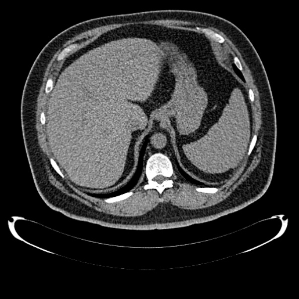 Bosniak renal cyst - type IV (Radiopaedia 24244-24518 Axial non-contrast 81).jpg