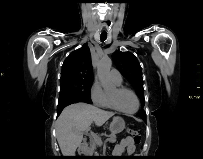 Brachial artery foreign body (Radiopaedia 54583-60820 Coronal non-contrast 21).jpg