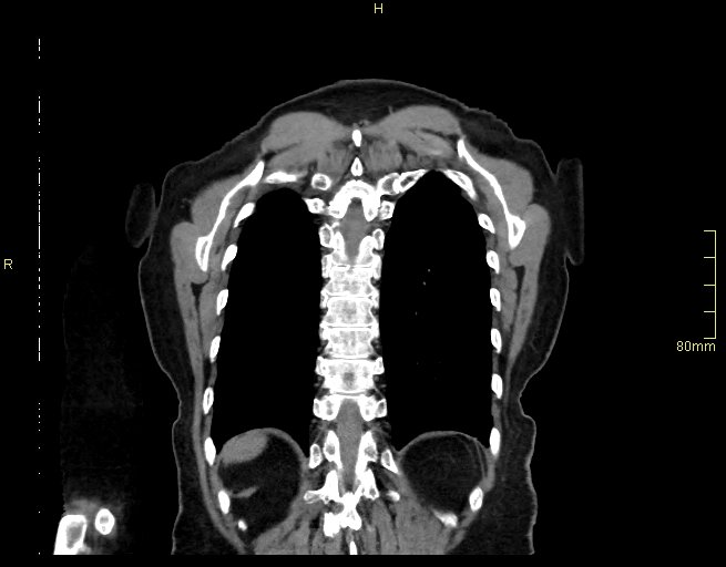 Brachial artery foreign body (Radiopaedia 54583-60820 Coronal non-contrast 50).jpg