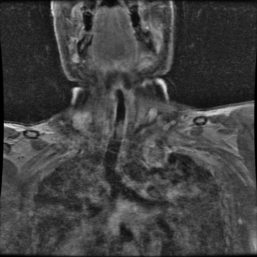 File:Brachial plexus neurofibroma (Radiopaedia 28030-28291 H 5).png
