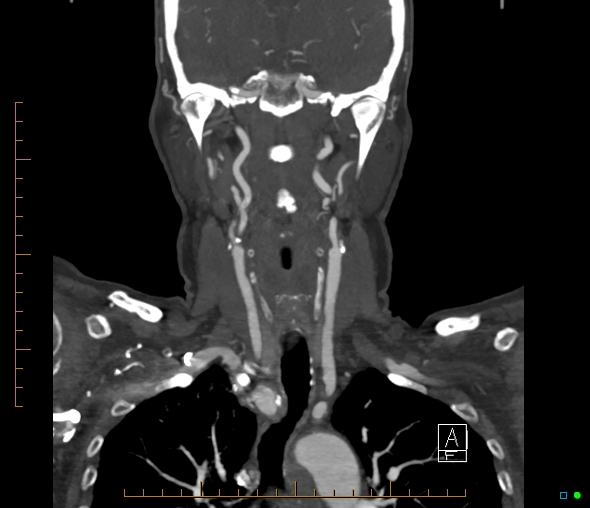 Brachiocephalic trunk stenosis (Radiopaedia 87242-103519 B 37).jpg