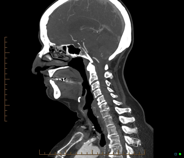 Brachiocephalic trunk stenosis (Radiopaedia 87242-103519 C 32).jpg