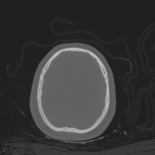 File:Brain contusions, internal carotid artery dissection and base of skull fracture (Radiopaedia 34089-35339 Axial bone window 99).png