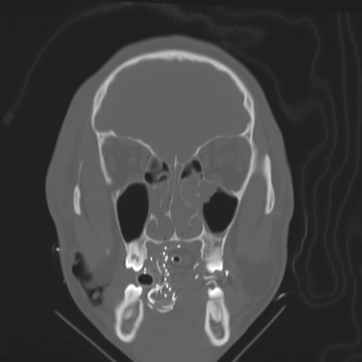 Brain contusions, internal carotid artery dissection and base of skull fracture (Radiopaedia 34089-35339 Coronal bone window 21).png