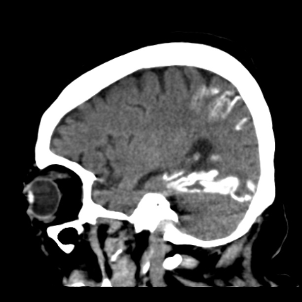 Brain cortical laminar necrosis (Radiopaedia 25822-25971 non-contrast 36).jpg