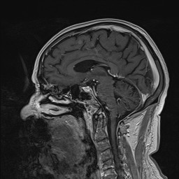 Brain metastasis (Radiopaedia 42617-45761 Sagittal T1 C+ 46).jpg