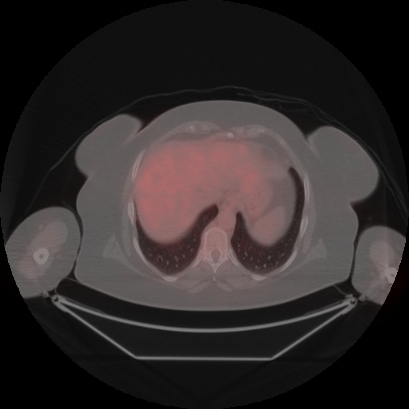 Brain metastasis (Radiopaedia 89847-106962 Axial lung window 51).jpg