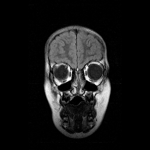 File:Brainstem ganglioglioma (Radiopaedia 10763-11224 Coronal FLAIR 17).jpg