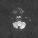 Brainstem glioma (Radiopaedia 67531-76922 Axial DWI 51).jpg
