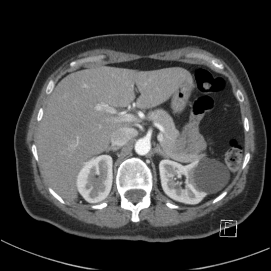 Breast metastases from renal cell cancer (Radiopaedia 79220-92225 A 93).jpg