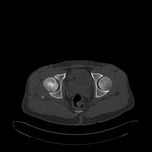 Brodie abscess- femoral neck (Radiopaedia 53862-59966 Axial bone window 142).jpg
