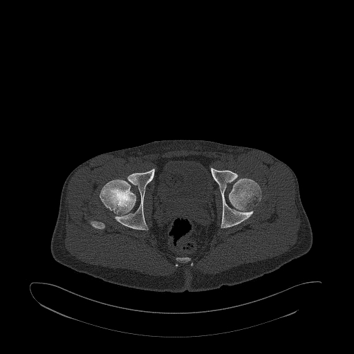 Brodie abscess- femoral neck (Radiopaedia 53862-59966 Axial bone window 145).jpg