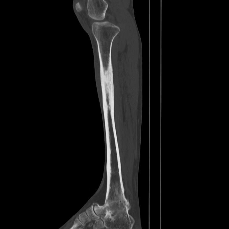 Brodie abscess - tibia (Radiopaedia 66028-75204 Sagittal bone window 26).jpg