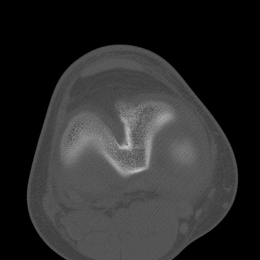 Brodie abscess of the tibia (Radiopaedia 58984-66250 Axial bone window 55).jpg