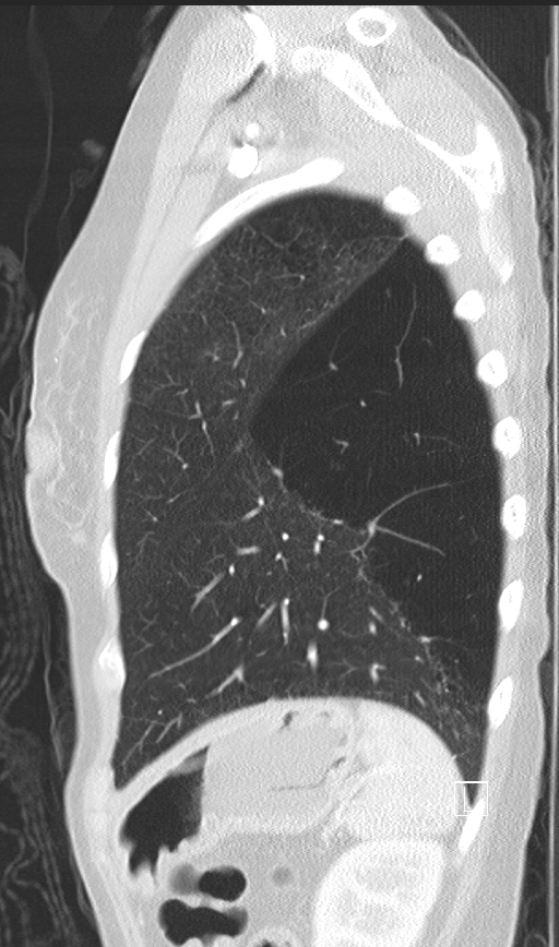 Bronchial atresia (Radiopaedia 73677-84470 Sagittal lung window 45).jpg