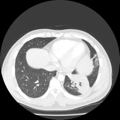 Bronchial carcinoid (Radiopaedia 80013-93291 Axial lung window 95).jpg