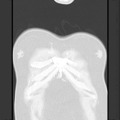 Bronchial carcinoid tumor (Radiopaedia 67377-76764 Coronal lung window 15).jpg