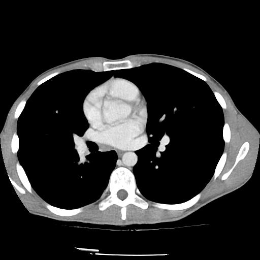 Bronchial carcinoid tumor causing right lower lobe collapse (Radiopaedia 83495-98594 A 27).jpg