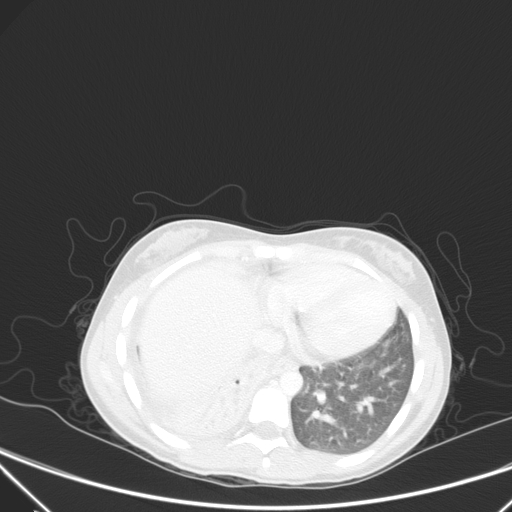 Bronchial mucoepidermoid carcinoma (Radiopaedia 57023-63895 Axial lung window 82).jpg