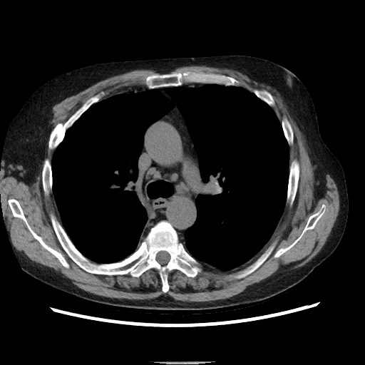 Bronchial stenosis - lung transplant (Radiopaedia 73133-83848 Axial non-contrast 25).jpg