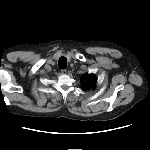 Bronchial stenosis - lung transplant (Radiopaedia 73133-83848 Axial non-contrast 6).jpg