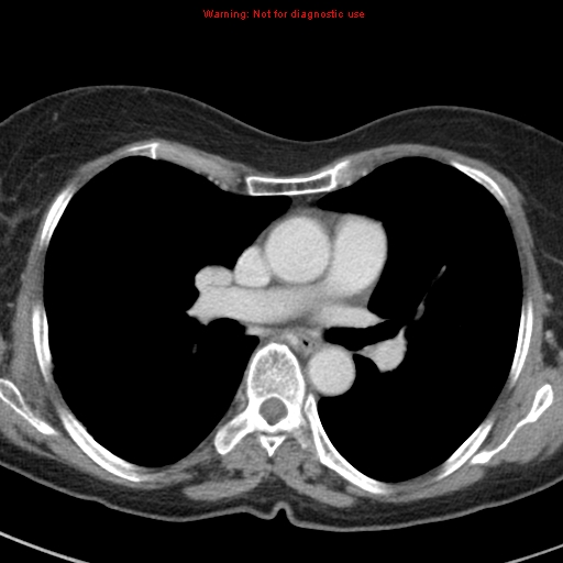 File:Bronchoalveolar carcinoma (BAC) (Radiopaedia 13436-13392 B 26).jpg