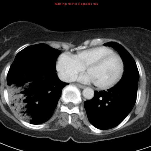 File:Bronchoalveolar carcinoma (BAC) (Radiopaedia 13436-13392 B 37).jpg
