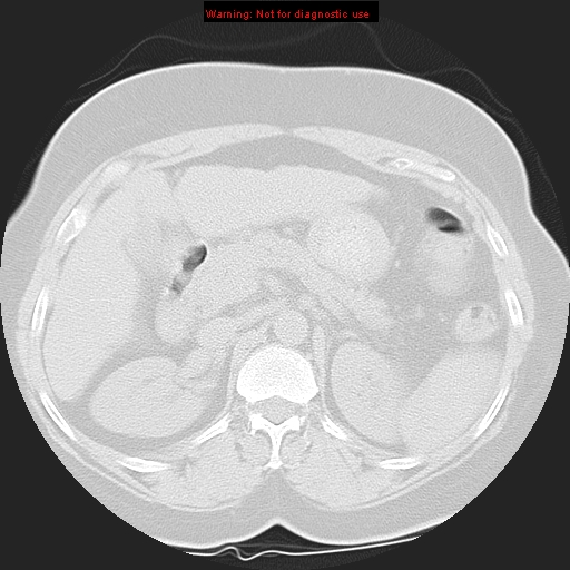 Bronchoalveolar carcinoma (Radiopaedia 13224-13233 Axial lung window 53).jpg