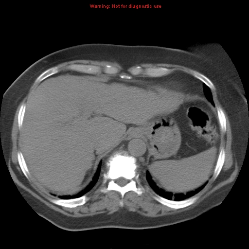 Bronchoalveolar carcinoma (Radiopaedia 13224-13233 Axial non-contrast 38).jpg