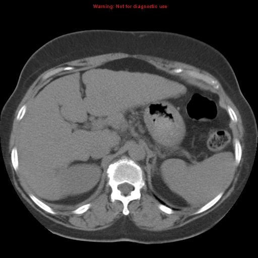 File:Bronchoalveolar carcinoma (Radiopaedia 13224-13233 Axial non-contrast 49).jpg