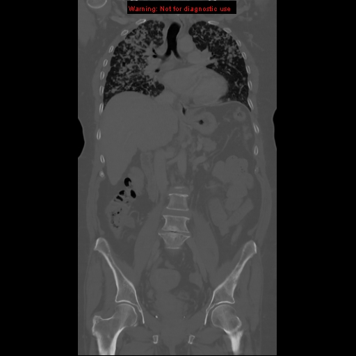 File:Bronchoalveolar carcinoma (Radiopaedia 13224-13233 Coronal non-contrast 9).jpg
