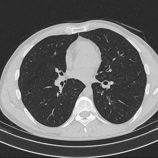 Bronchocele (Radiopaedia 60676-68429 Axial lung window 39).jpg
