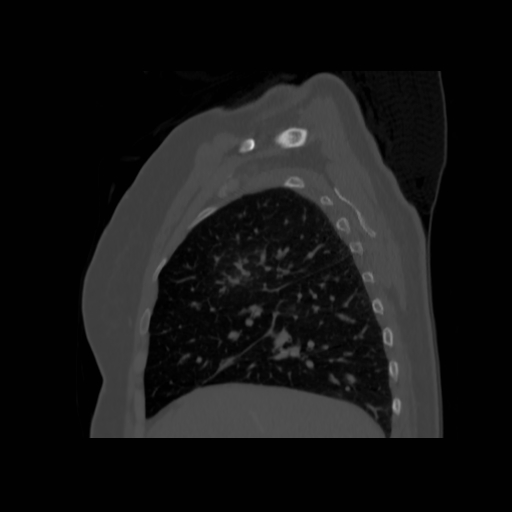 Bronchogenic carcinoma (Radiopaedia 73497-84262 Sagittal bone window 51).jpg