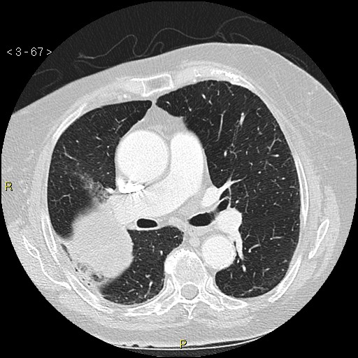 Bronchogenic carcinoma as an incidental finding (Radiopaedia 16453-16130 Axial lung window 67).jpg
