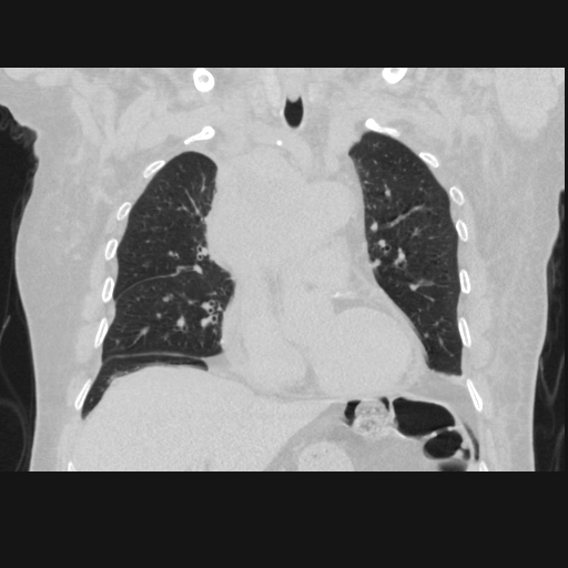 File:Bronchogenic carcinoma with metastatic lymphadenopathy (Radiopaedia 37671-39569 Coronal lung window 19).jpg