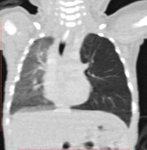 Bronchogenic cyst (Radiopaedia 78599-91409 Coronal lung window 115).jpg