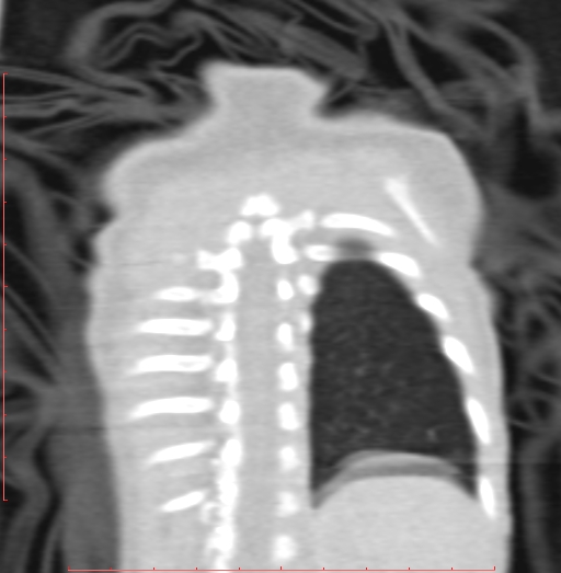 Bronchogenic cyst (Radiopaedia 78599-91409 Coronal lung window 195).jpg