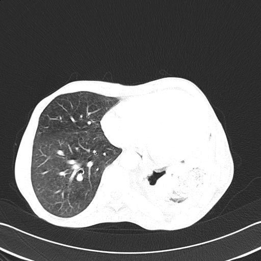 Bronchopleural fistula secondary to tuberculosis (Radiopaedia 20415-20322 Axial lung window 40).jpg