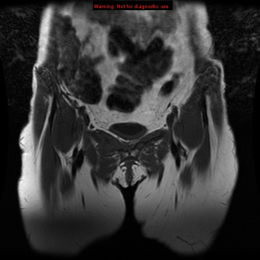 File:Brown tumors (Radiopaedia 9666-10290 Coronal T1 4).jpg