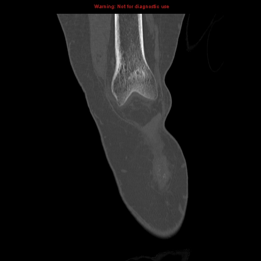 File:Brown tumors (Radiopaedia 9666-10291 Coronal bone window 3).jpg