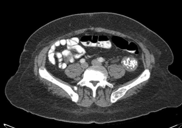 File:Brown tumors compressing the spinal cord (Radiopaedia 68442-77988 E 84).jpg