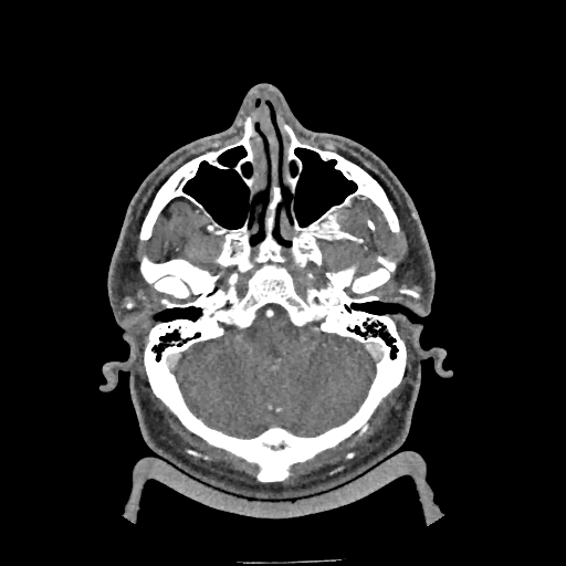 Buccal fat pad arteriovenous malformation (Radiopaedia 70936-81144 D 248).jpg