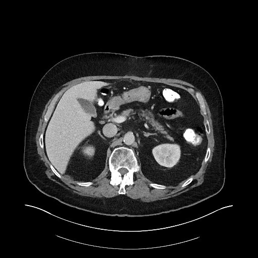Buried bumper syndrome - gastrostomy tube (Radiopaedia 63843-72575 A 19).jpg